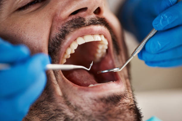 Best Emergency Tooth Extraction  in Perezville, TX