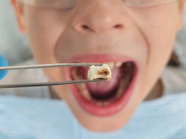 Best Broken Tooth Emergency  in Perezville, TX